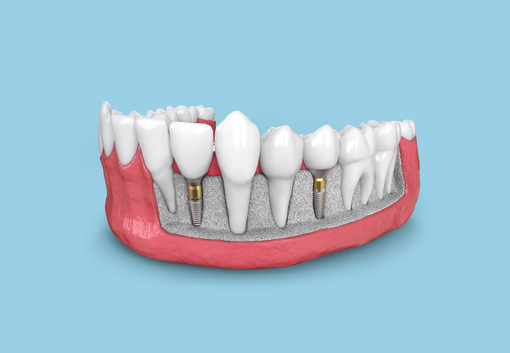 Dental Implant