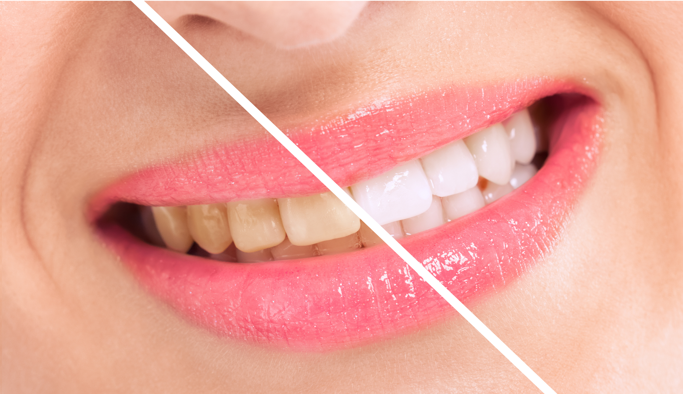 Professional Teeth Whitening